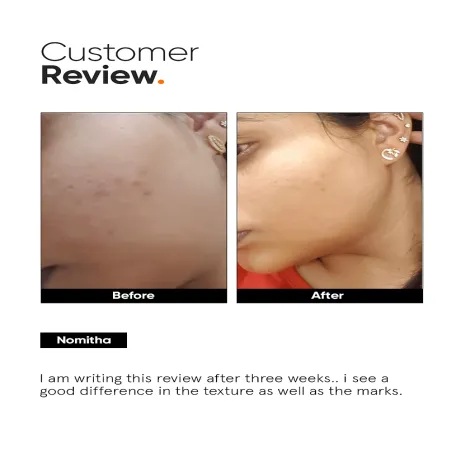Minimalist 32% AHA PHA BHA Peel for Instant Glow & Soft Skin 30ml (India)